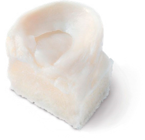 trasplante meniscal